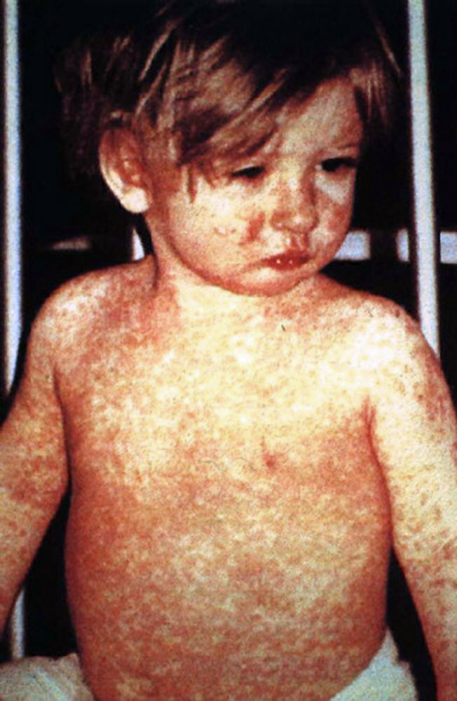 Tuhkarokkoon sairastunut lapsi, jonka kasvoilla ja vartalolla näkyy taudille tyypillistä ihottumaa. Kuva: CDC / NIP / Barbara Rice / Wikimedia Commons, Public Domain